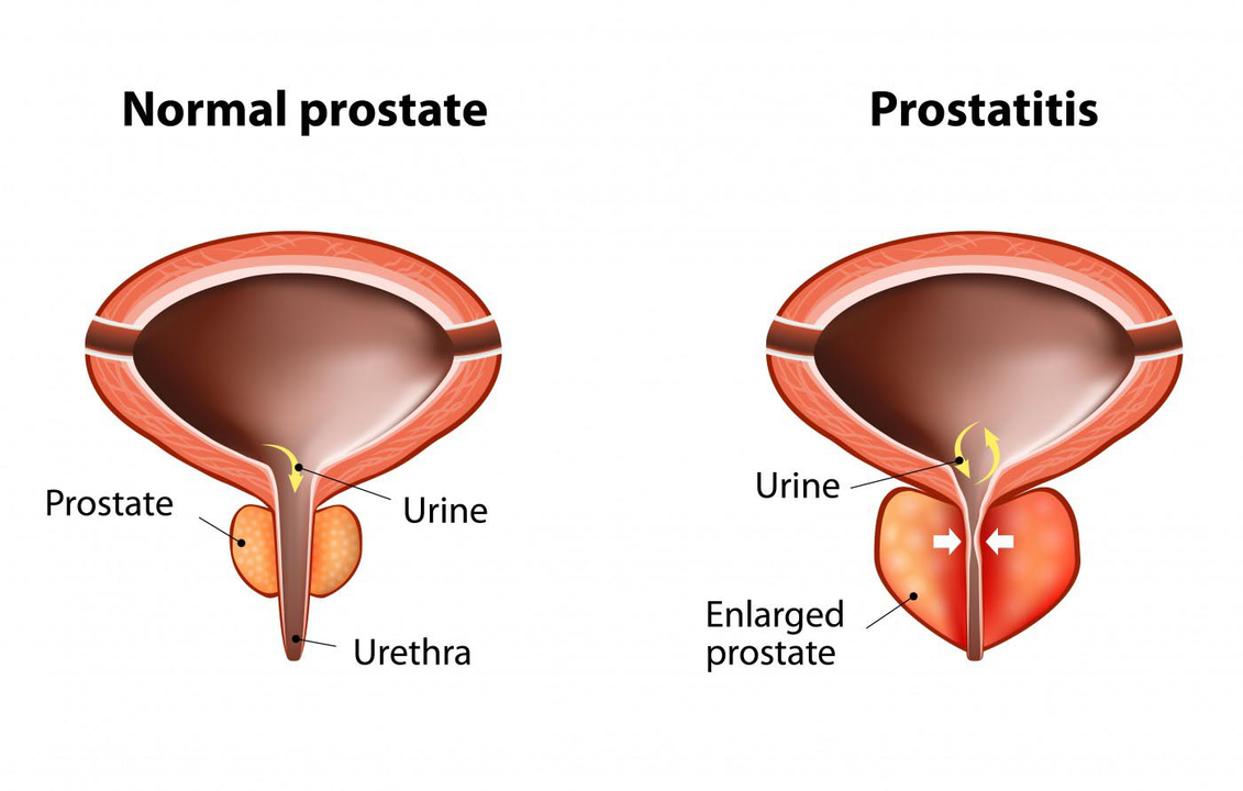 Normal prostate of healthy men and inflammation of the prostate gland with prostatitis